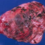 Solitary Fibrous Tumors