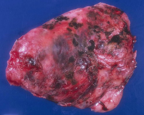 Solitary Fibrous Tumors