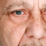 Myasthenia Gravis Sarcoidosis