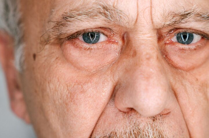 Myasthenia Gravis Sarcoidosis
